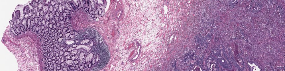 H&E section of colon: normal crypts and a lymphoid aggregate on the left, desmoplastic stroma in the middle, invasive adenocarcinoma on the right